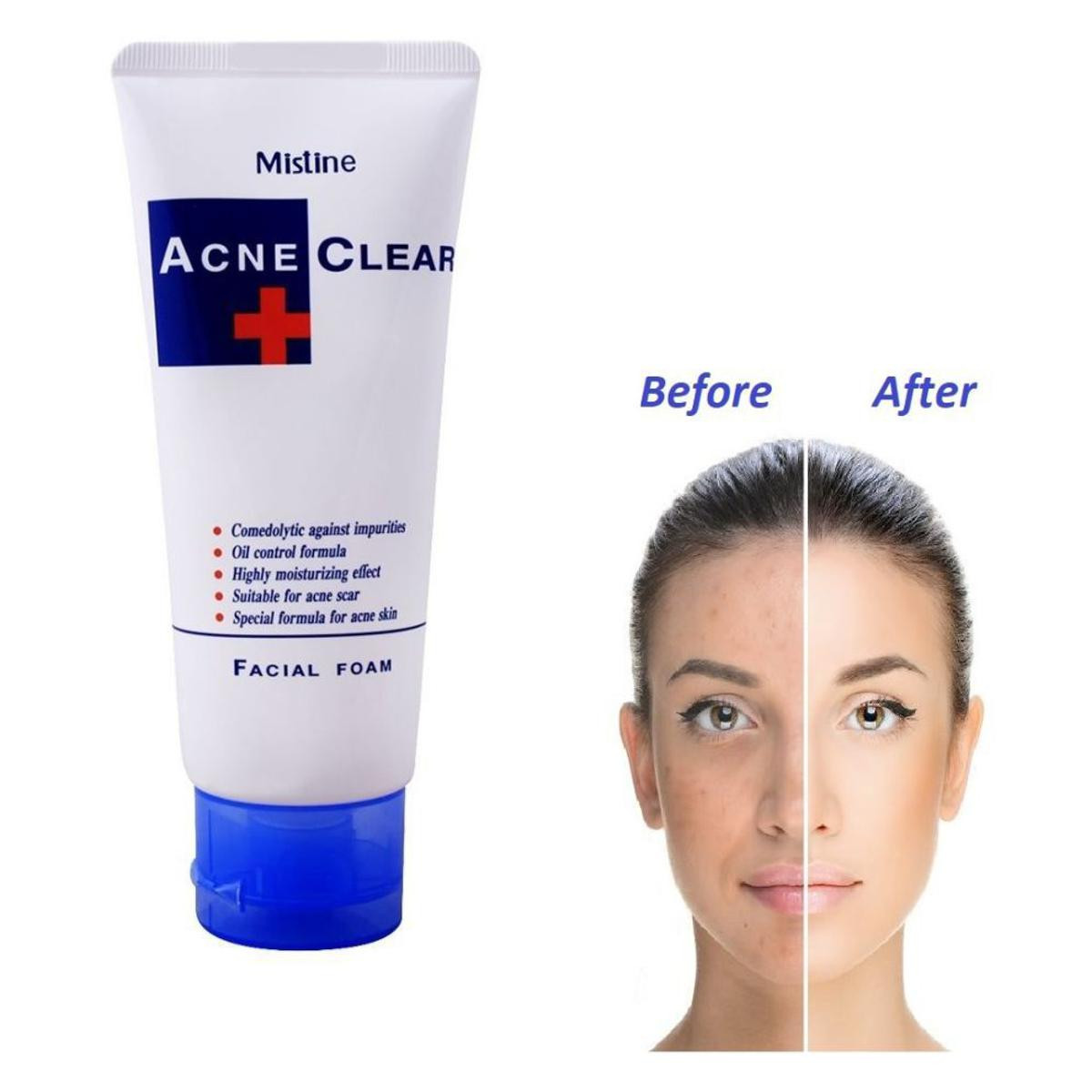 Mistine Acne Clear Facial Foam - 85g (Thailand)
